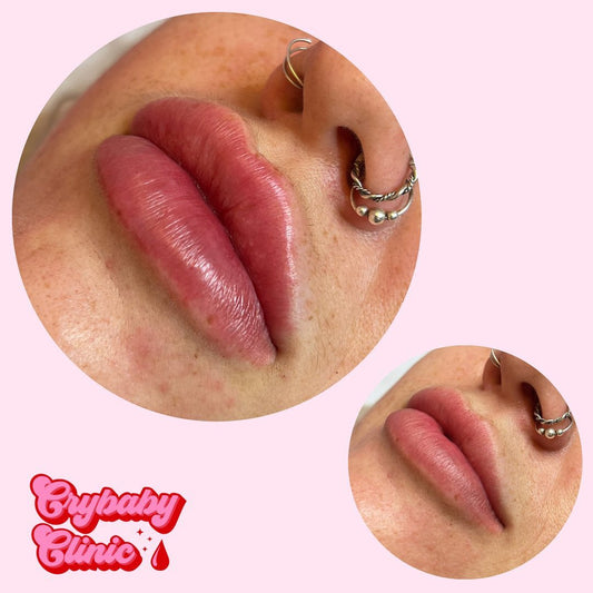 Best lip filler injections pembrokeshire south west wales
