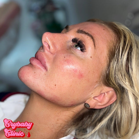 Dermal Filler
